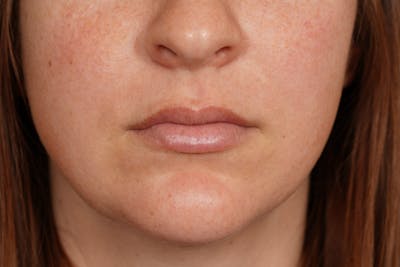Lip Filler Before & After Gallery - Patient 361082 - Image 2