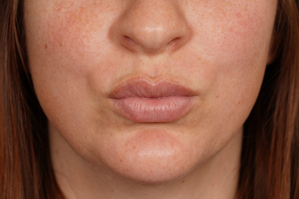 Lip Filler Before & After Gallery - Patient 361082 - Image 6