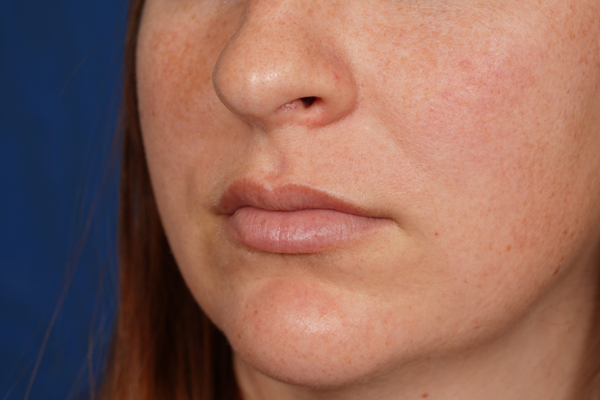 Lip Filler Before & After Gallery - Patient 361082 - Image 7