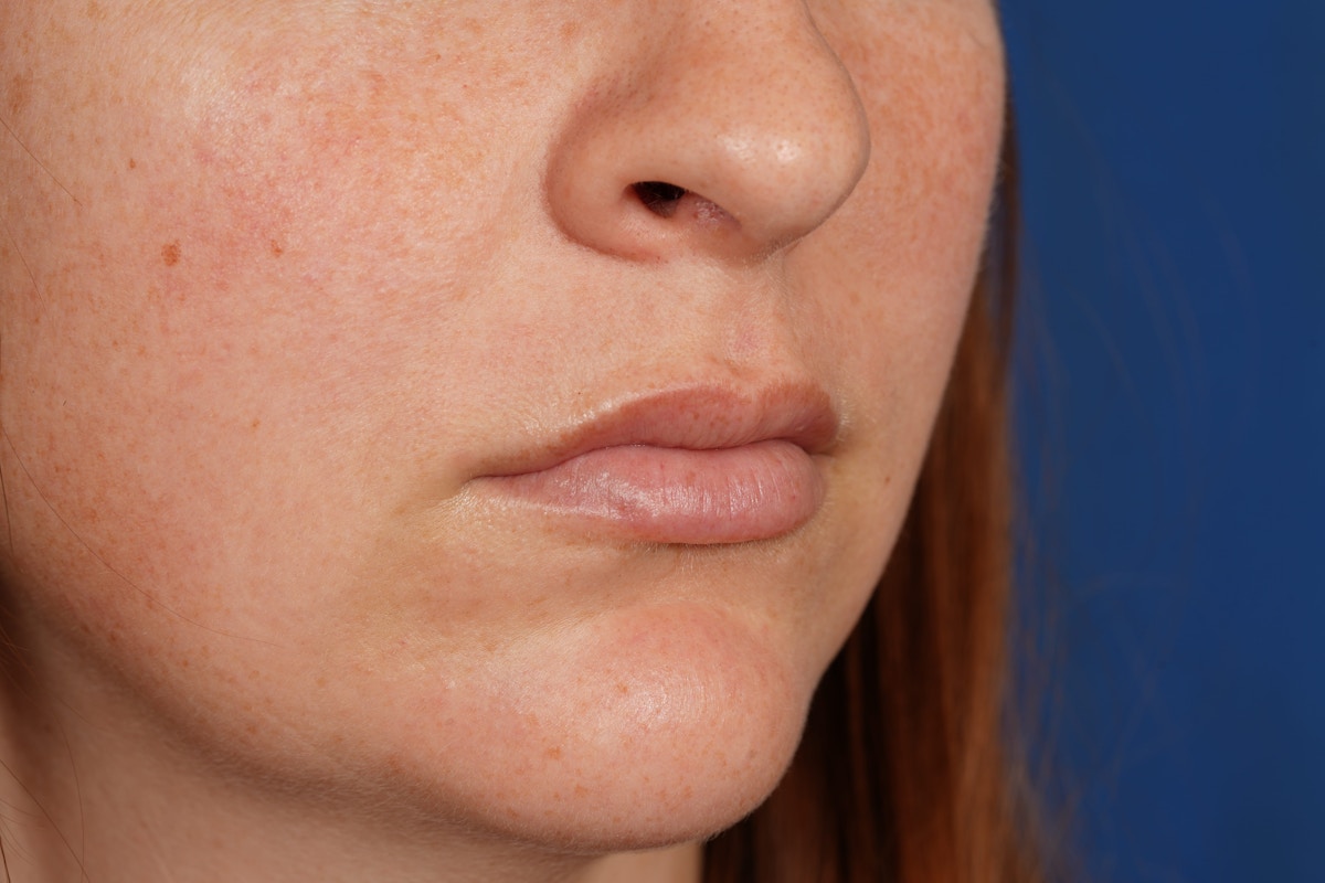 Lip Filler Before & After Gallery - Patient 361082 - Image 4