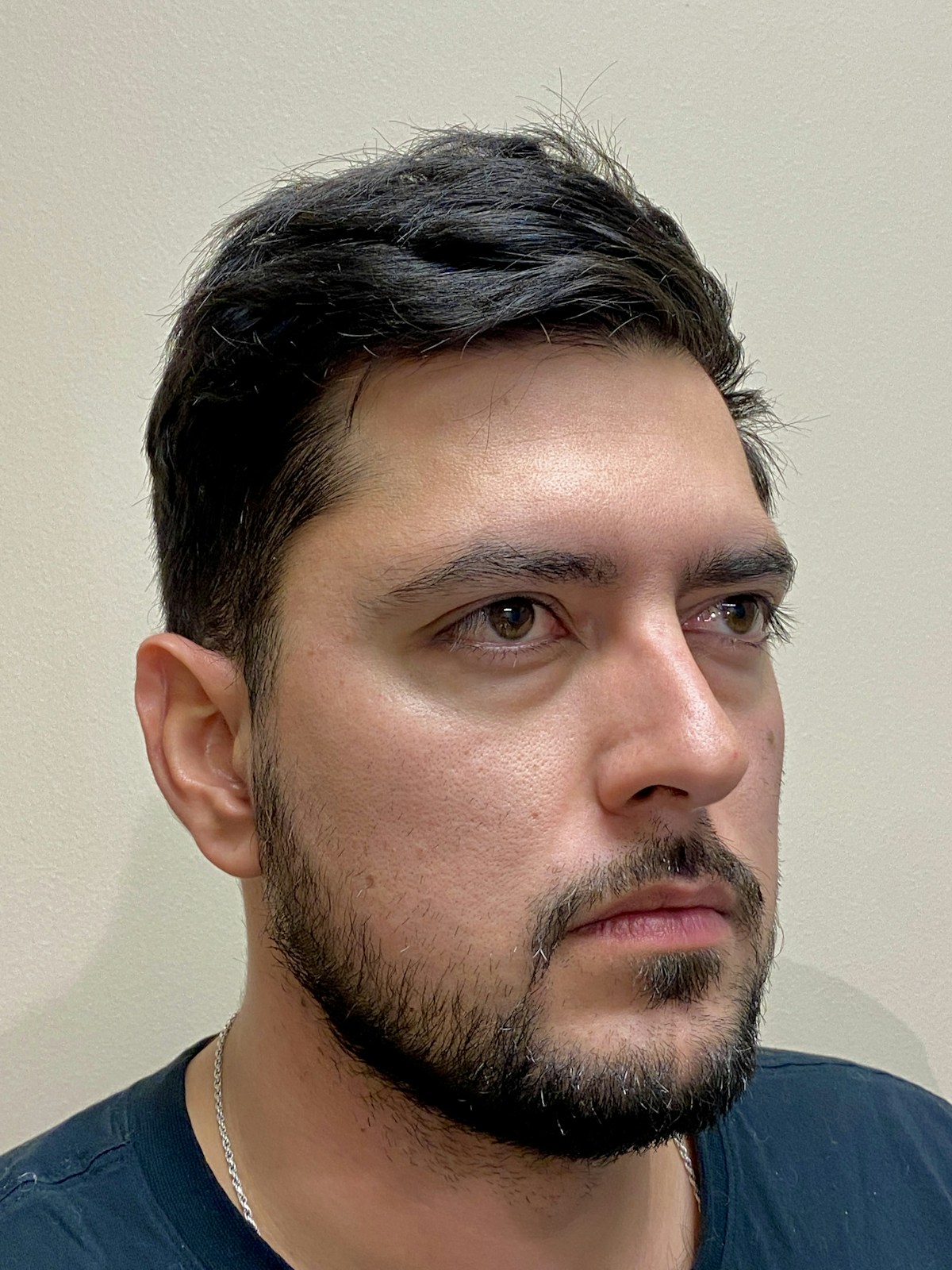 Functional Rhinoplasty Before & After Gallery - Patient 317750 - Image 1