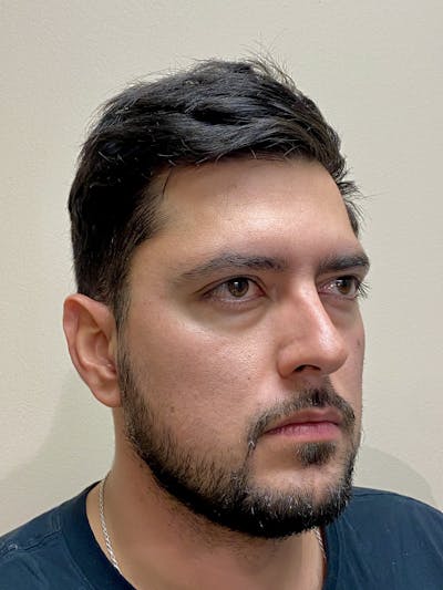 Functional Rhinoplasty Before & After Gallery - Patient 317750 - Image 1