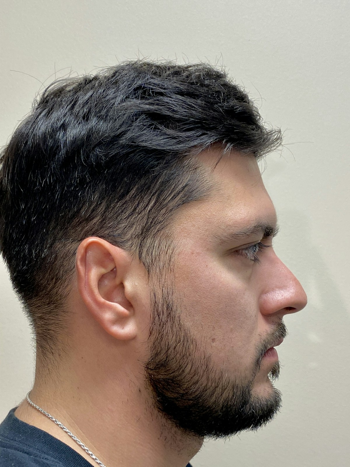 Functional Rhinoplasty Before & After Gallery - Patient 317750 - Image 3