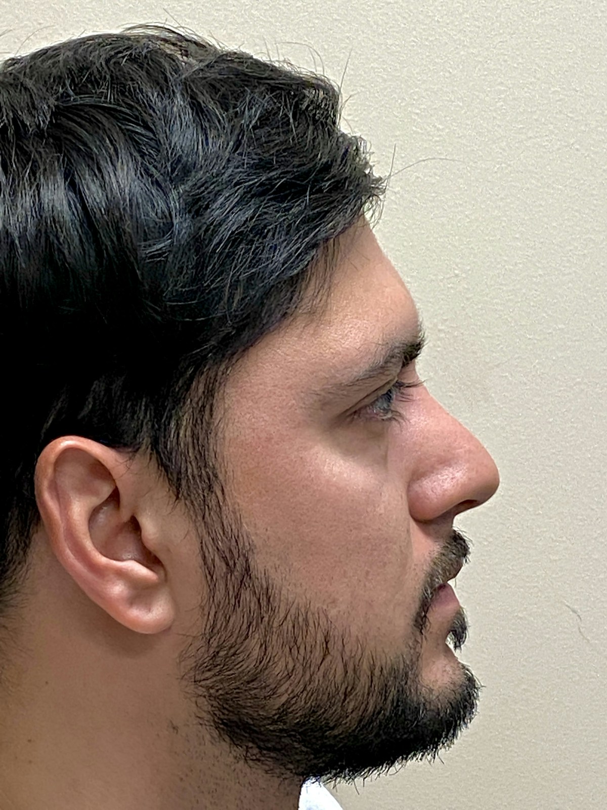 Functional Rhinoplasty Before & After Gallery - Patient 317750 - Image 4