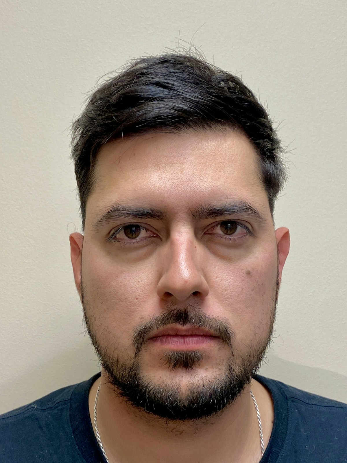 Functional Rhinoplasty Before & After Gallery - Patient 317750 - Image 5