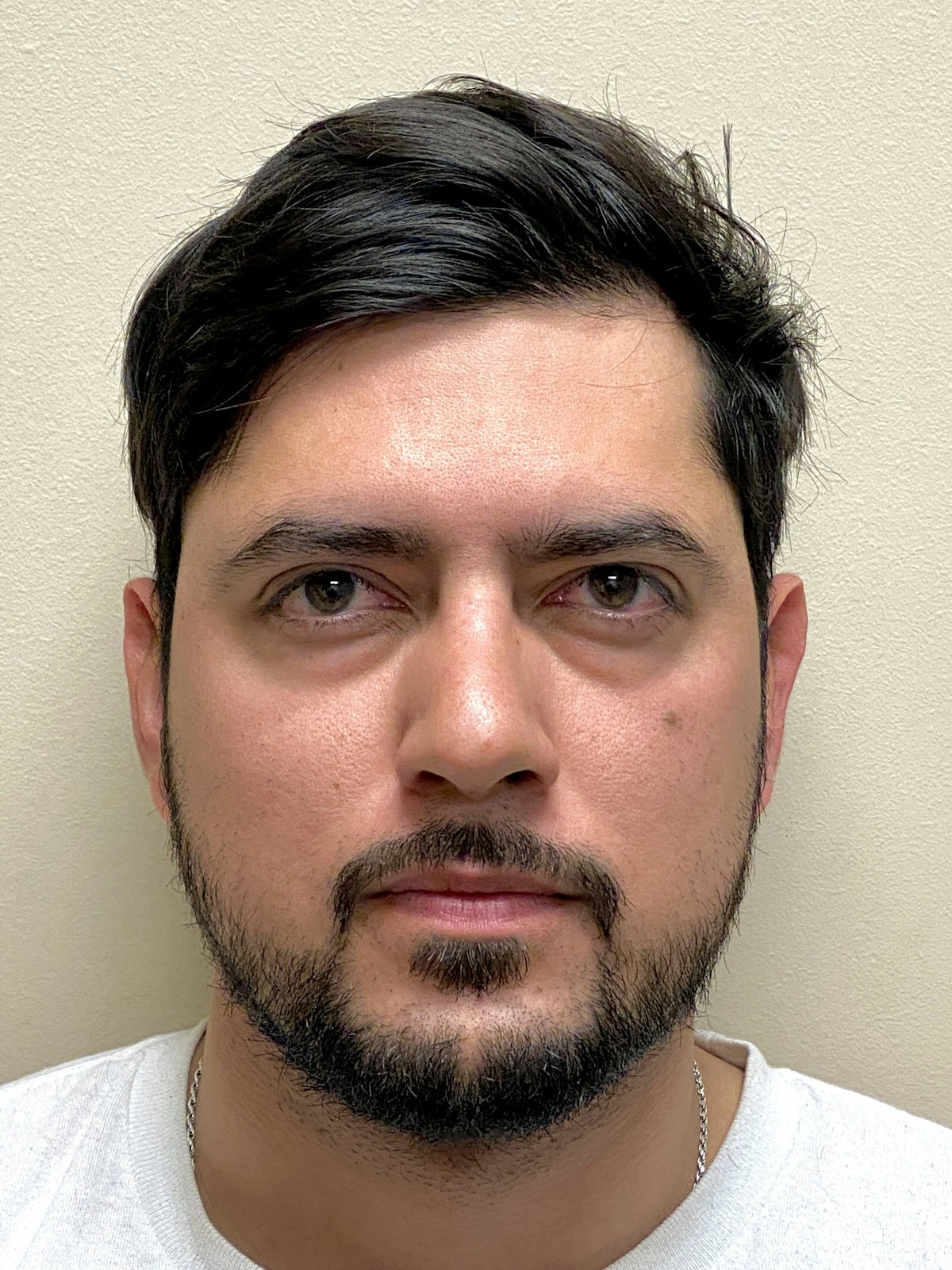 Functional Rhinoplasty Before & After Gallery - Patient 317750 - Image 6