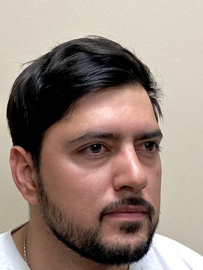 Functional Rhinoplasty Before & After Gallery - Patient 317750 - Image 2