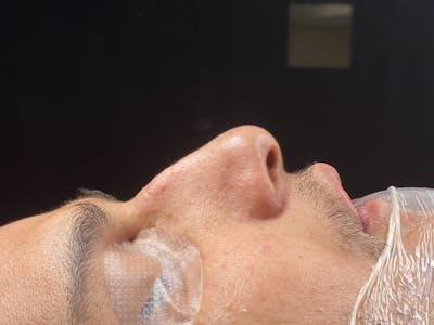 Functional Rhinoplasty Before & After Gallery - Patient 137739 - Image 1