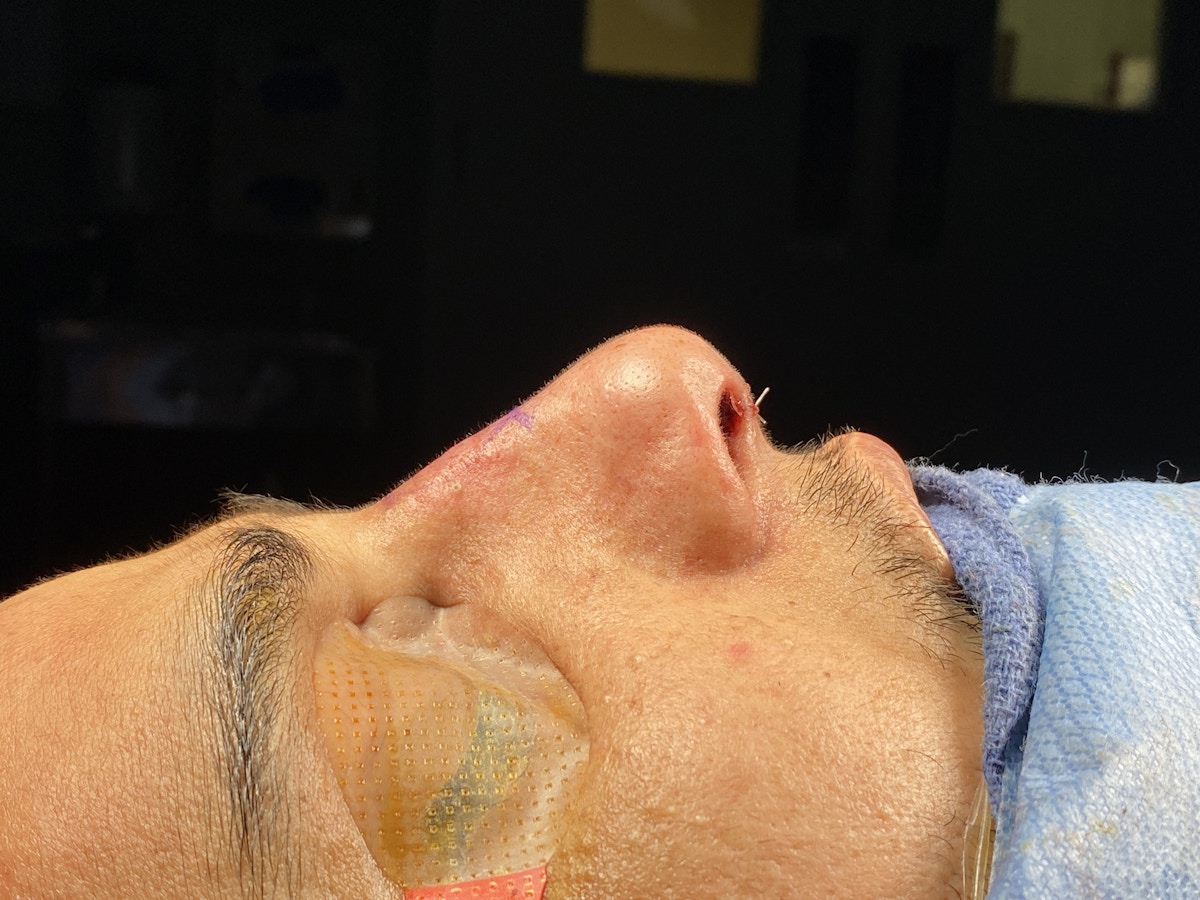 Functional Rhinoplasty Before & After Gallery - Patient 137739 - Image 2