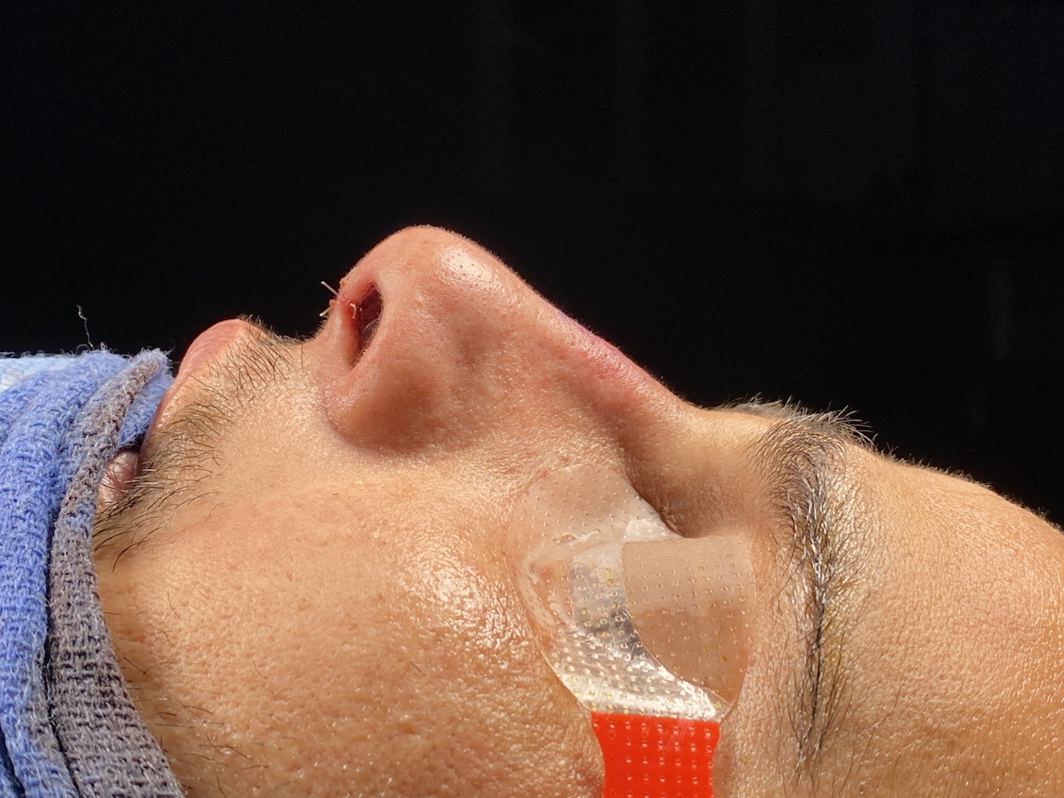 Functional Rhinoplasty Before & After Gallery - Patient 137739 - Image 4