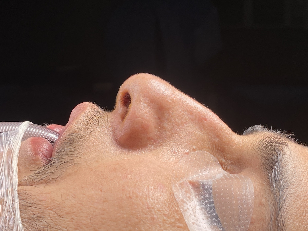 Functional Rhinoplasty Before & After Gallery - Patient 137739 - Image 3