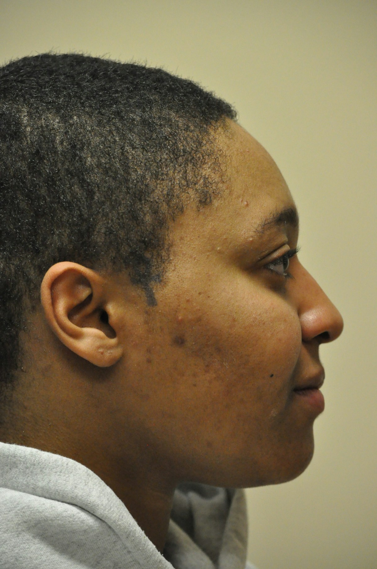 Functional Rhinoplasty Before & After Gallery - Patient 302925 - Image 3