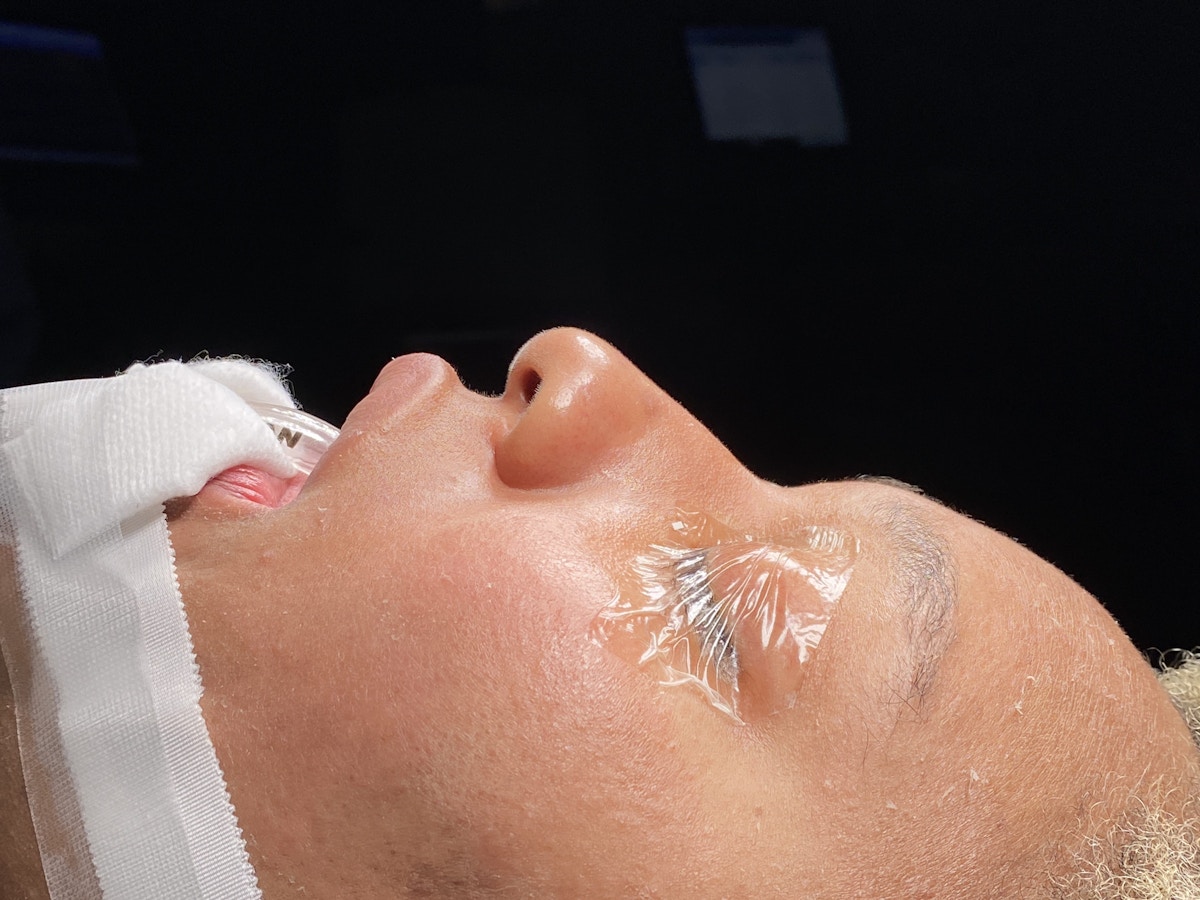 Functional Rhinoplasty Before & After Gallery - Patient 302925 - Image 13