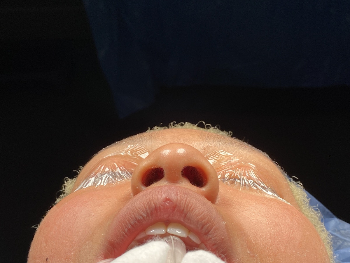 Functional Rhinoplasty Before & After Gallery - Patient 302925 - Image 15