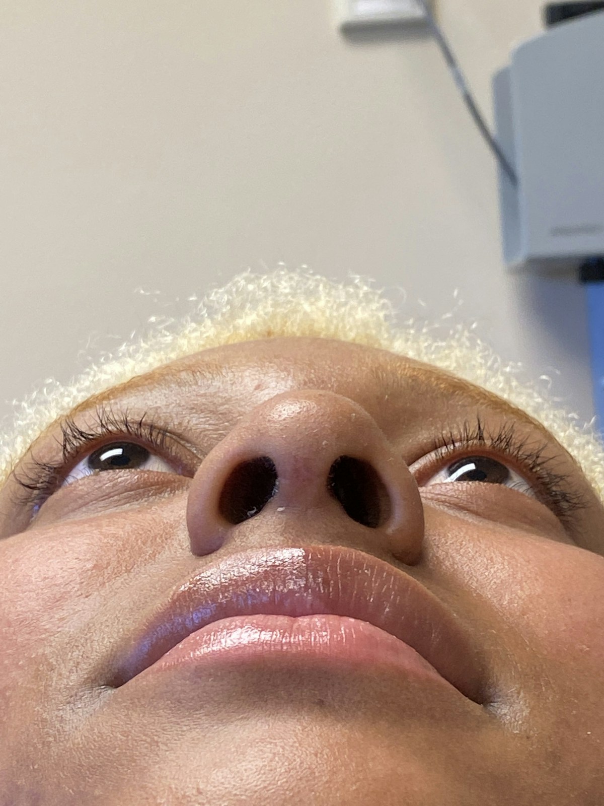 Functional Rhinoplasty Before & After Gallery - Patient 302925 - Image 6