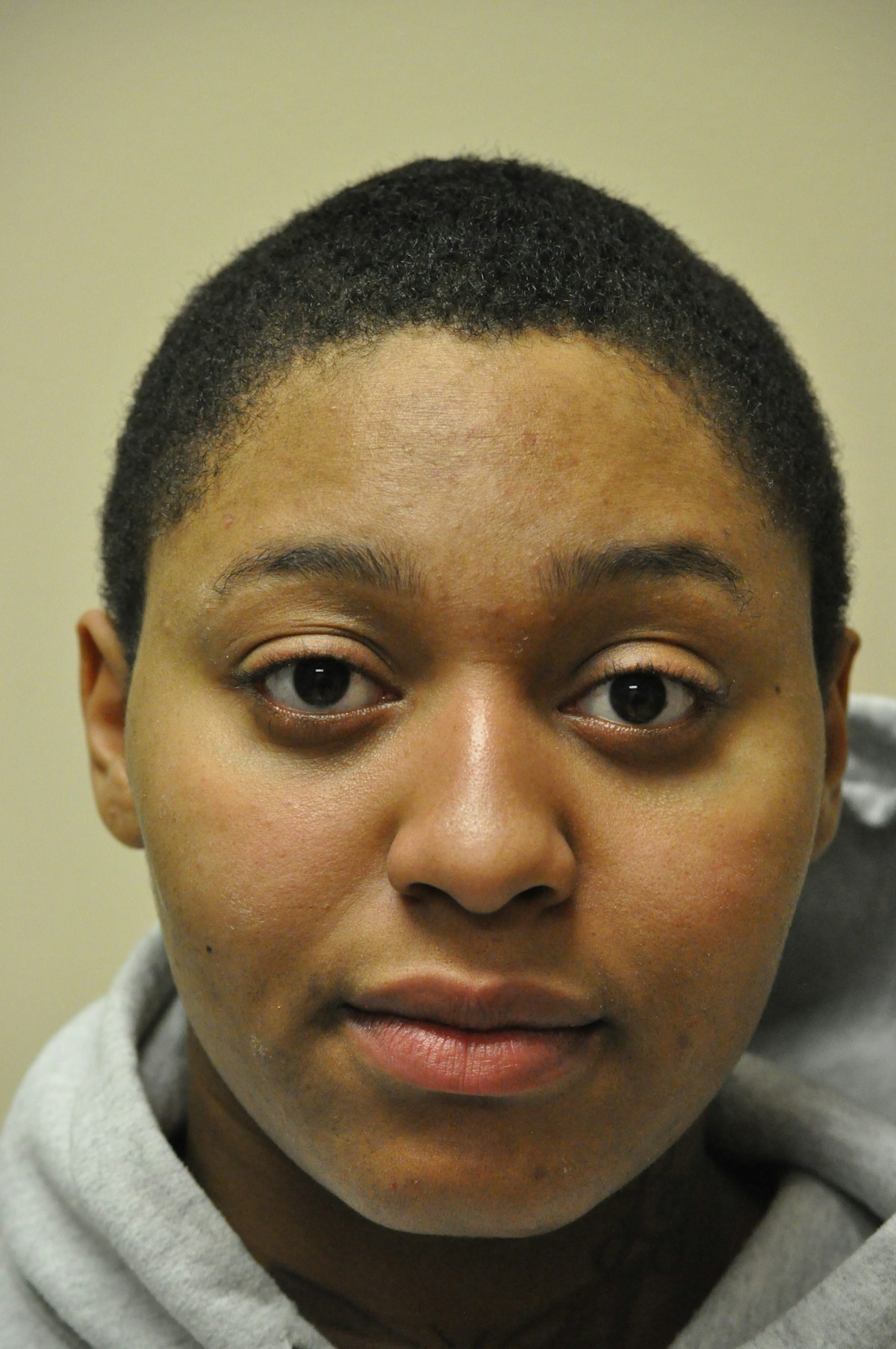 Functional Rhinoplasty Before & After Gallery - Patient 302925 - Image 7