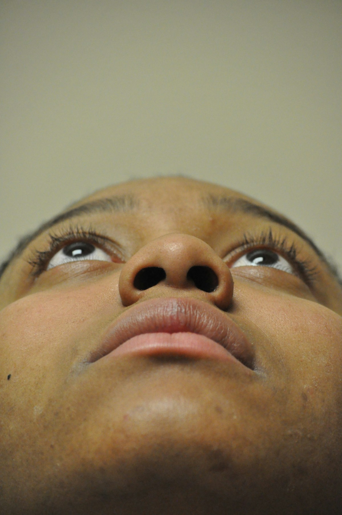 Functional Rhinoplasty Before & After Gallery - Patient 302925 - Image 5