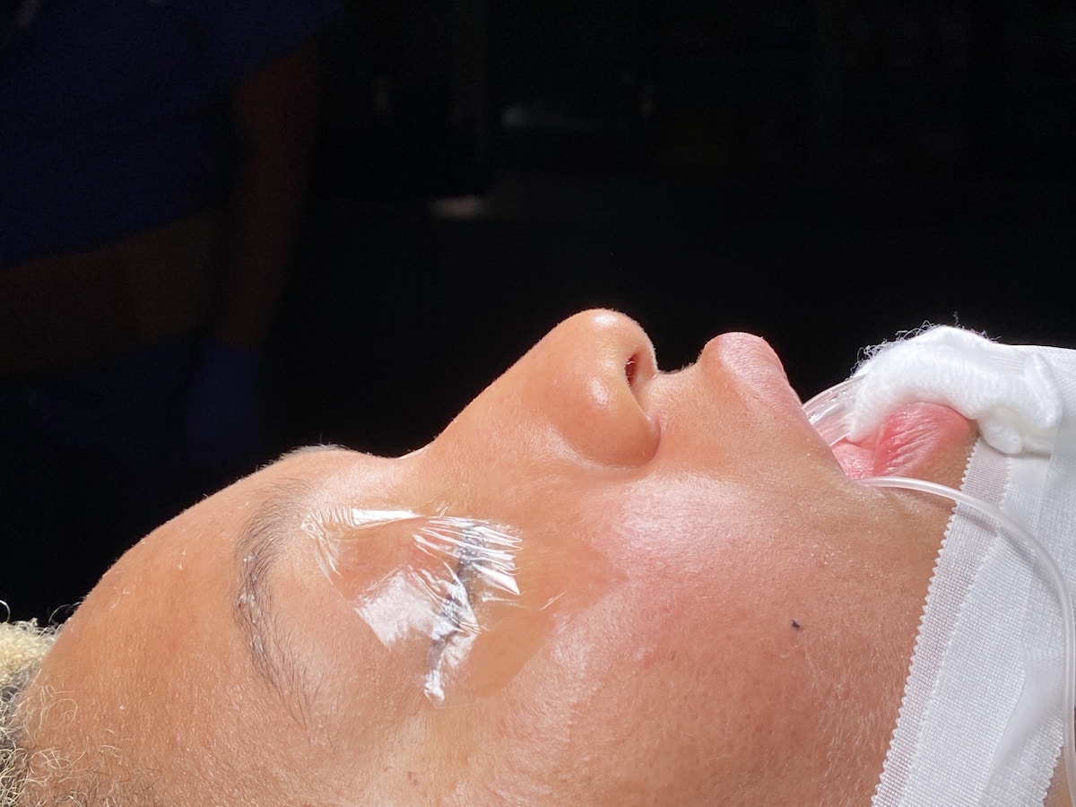 Functional Rhinoplasty Before & After Gallery - Patient 302925 - Image 17