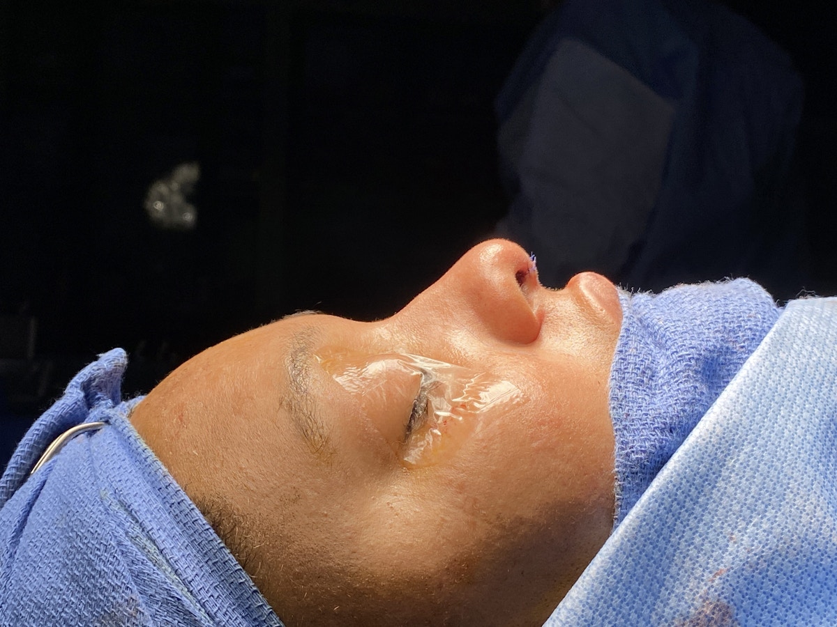 Functional Rhinoplasty Before & After Gallery - Patient 302925 - Image 18