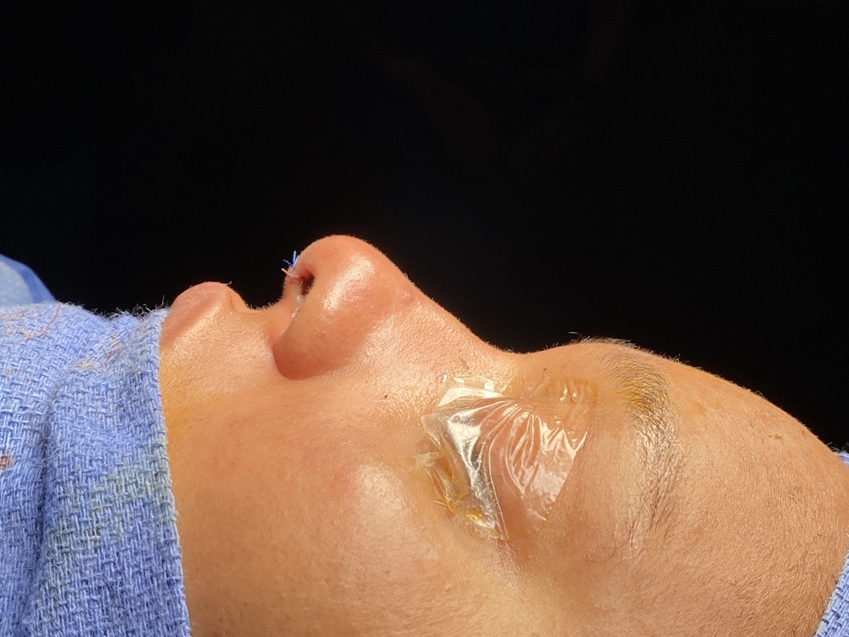 Functional Rhinoplasty Before & After Gallery - Patient 302925 - Image 14