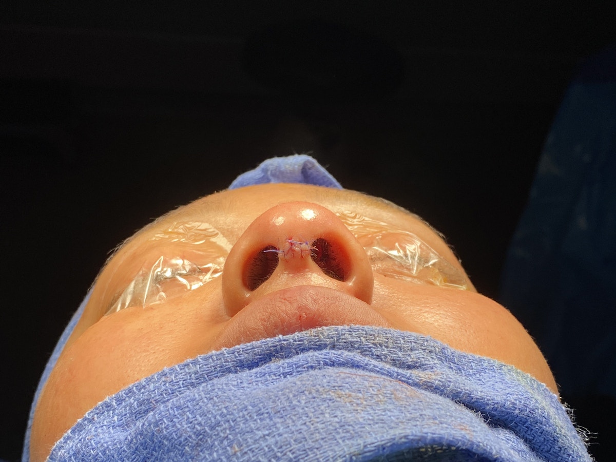 Functional Rhinoplasty Before & After Gallery - Patient 302925 - Image 16