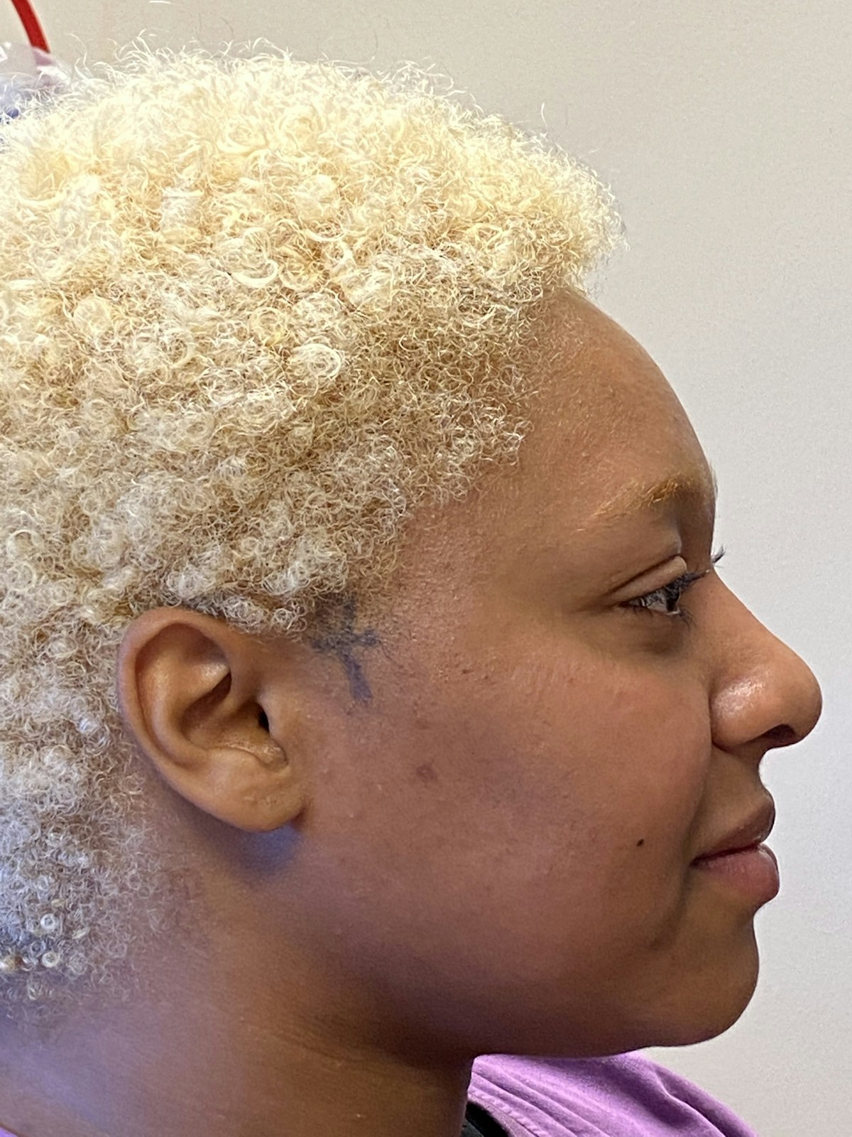 Functional Rhinoplasty Before & After Gallery - Patient 302925 - Image 4