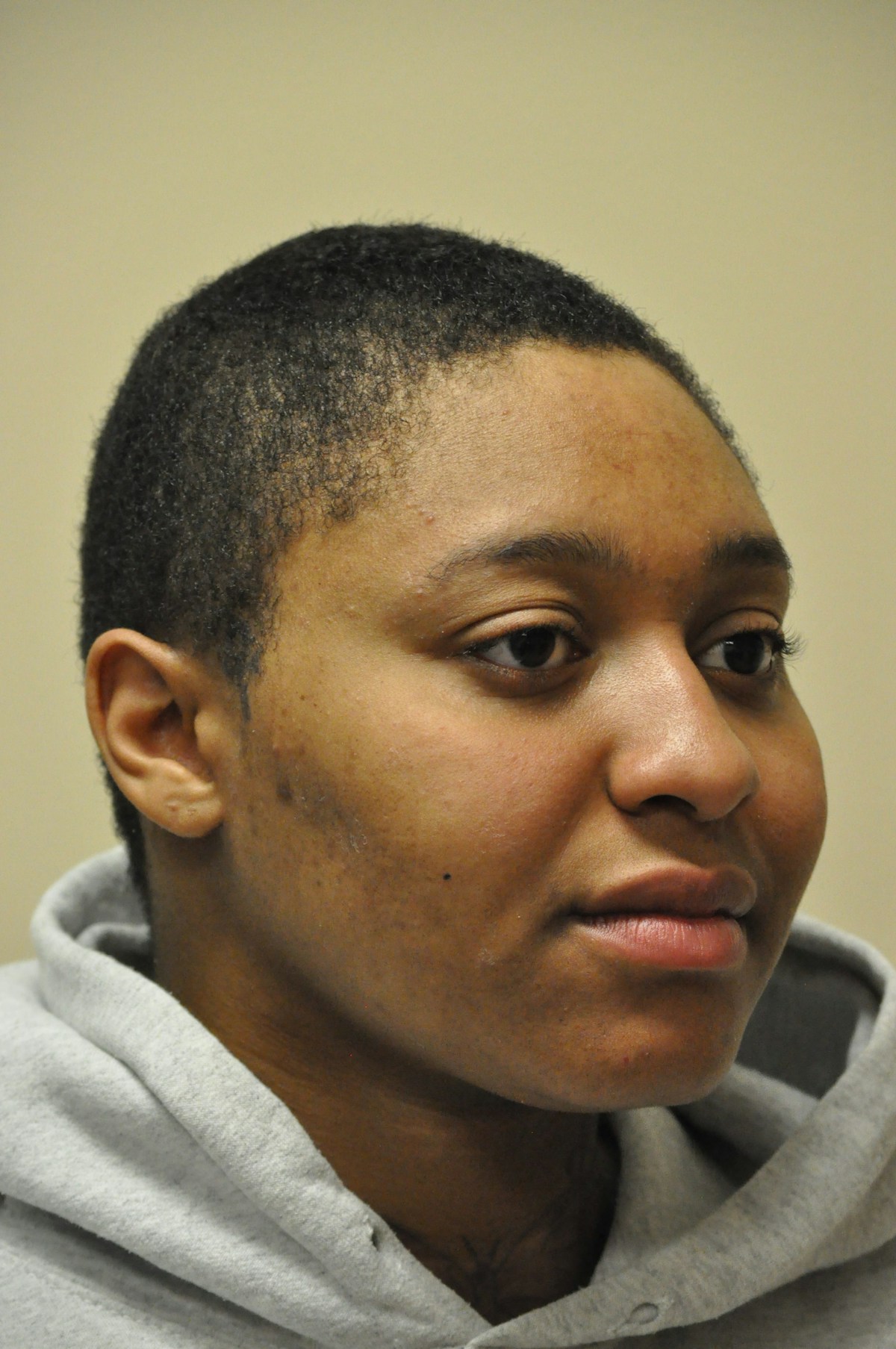 Functional Rhinoplasty Before & After Gallery - Patient 302925 - Image 11