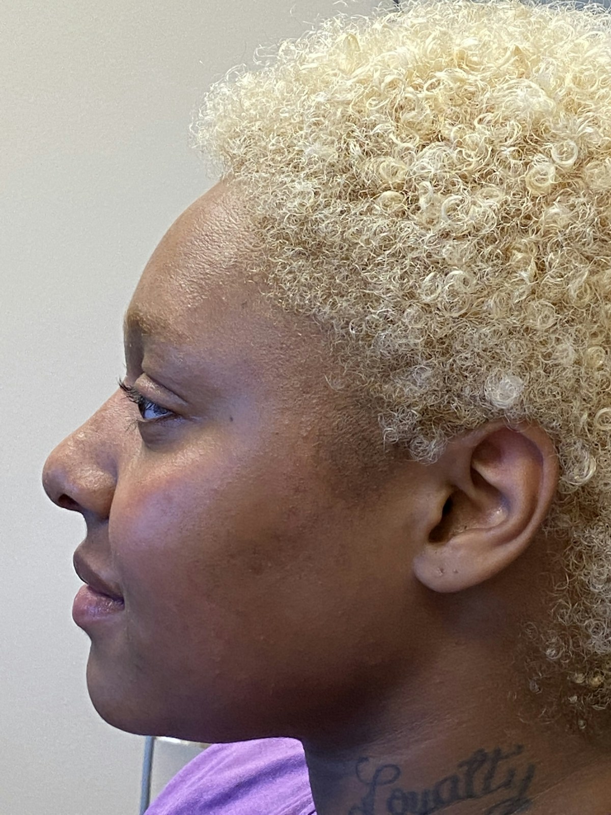 Functional Rhinoplasty Before & After Gallery - Patient 302925 - Image 10