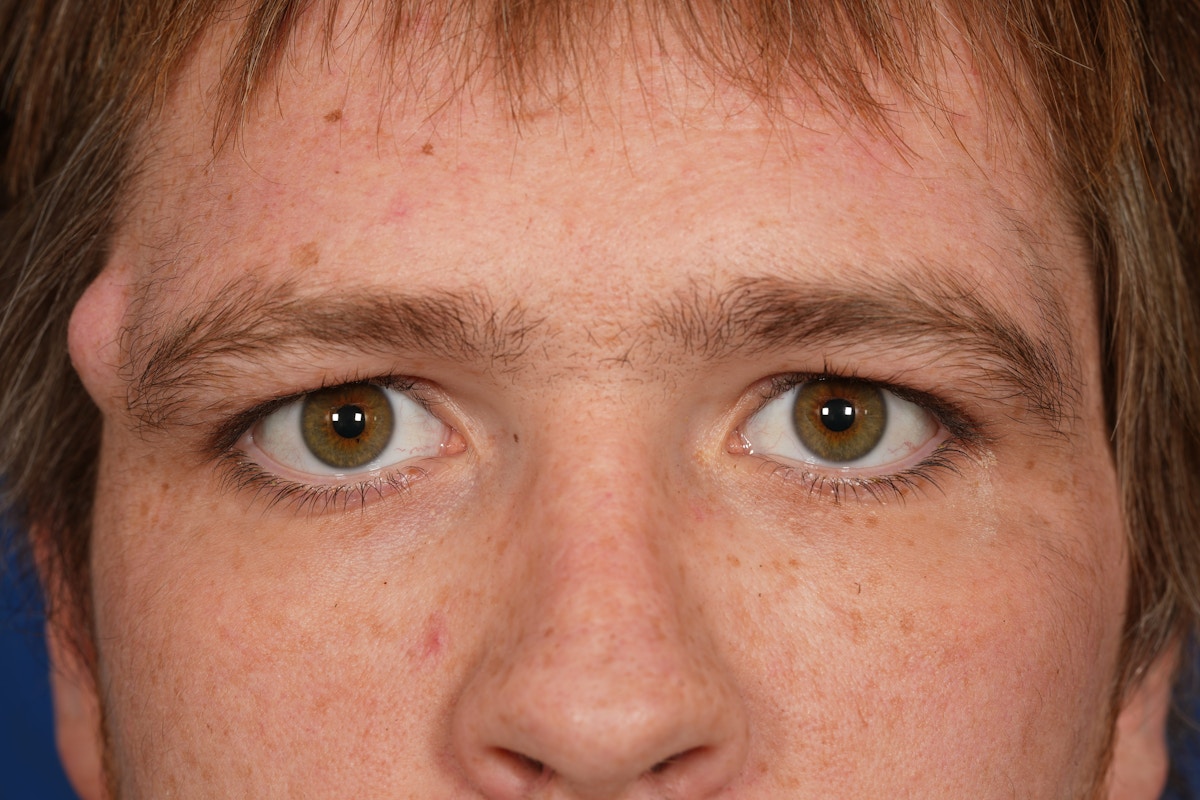 Lesion Excision Before & After Gallery - Patient 790316 - Image 1