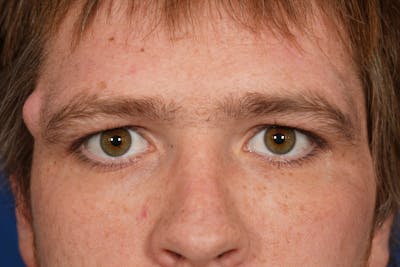Lesion Excision Before & After Gallery - Patient 790316 - Image 1