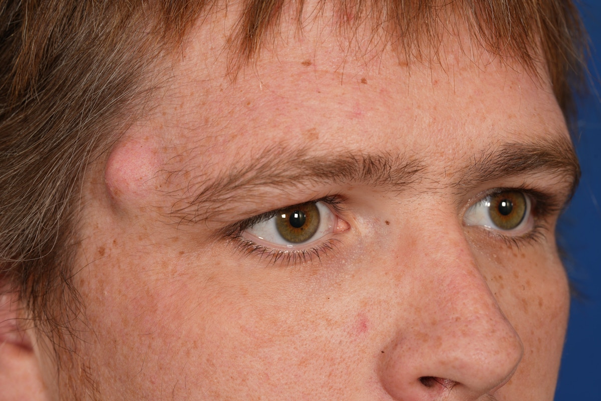 Lesion Excision Before & After Gallery - Patient 790316 - Image 3