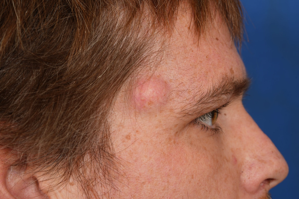 Lesion Excision Before & After Gallery - Patient 790316 - Image 5