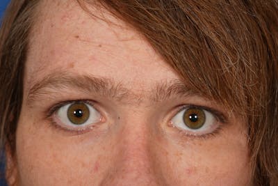 Lesion Excision Before & After Gallery - Patient 790316 - Image 2
