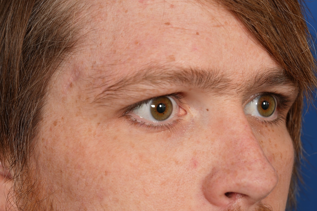 Lesion Excision Before & After Gallery - Patient 790316 - Image 4