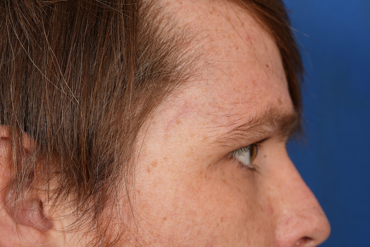 Lesion Excision Before & After Gallery - Patient 790316 - Image 6