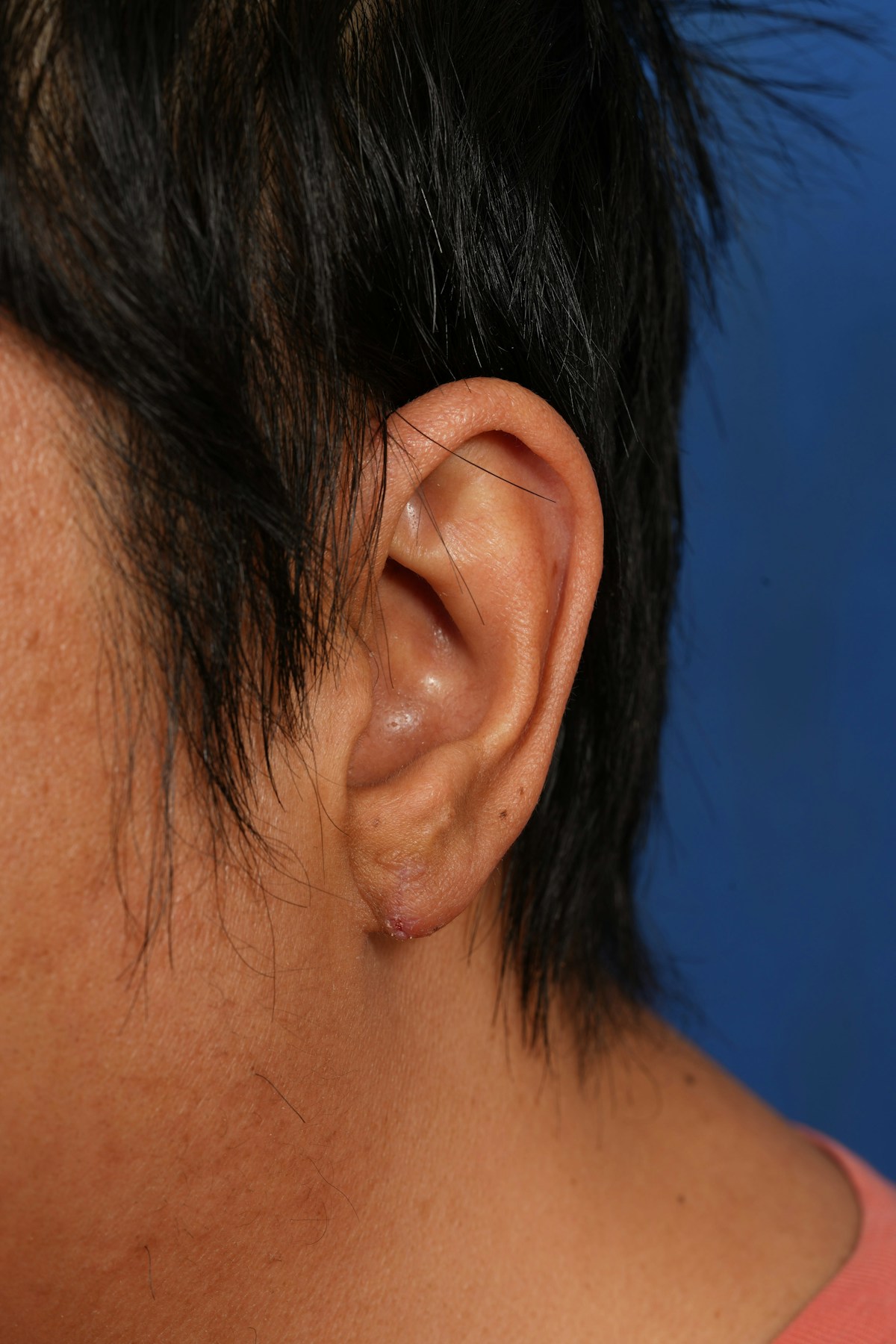 Keloid Removal Before & After Gallery - Patient 172564 - Image 2