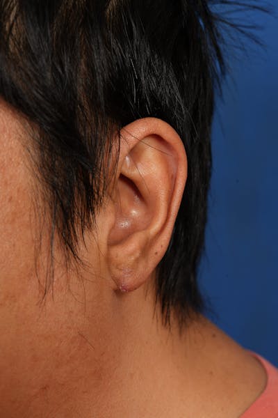 Keloid Removal Before & After Gallery - Patient 172564 - Image 2