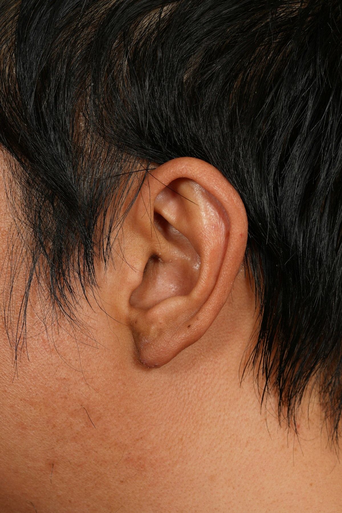 Keloid Removal Before & After Gallery - Patient 172564 - Image 4