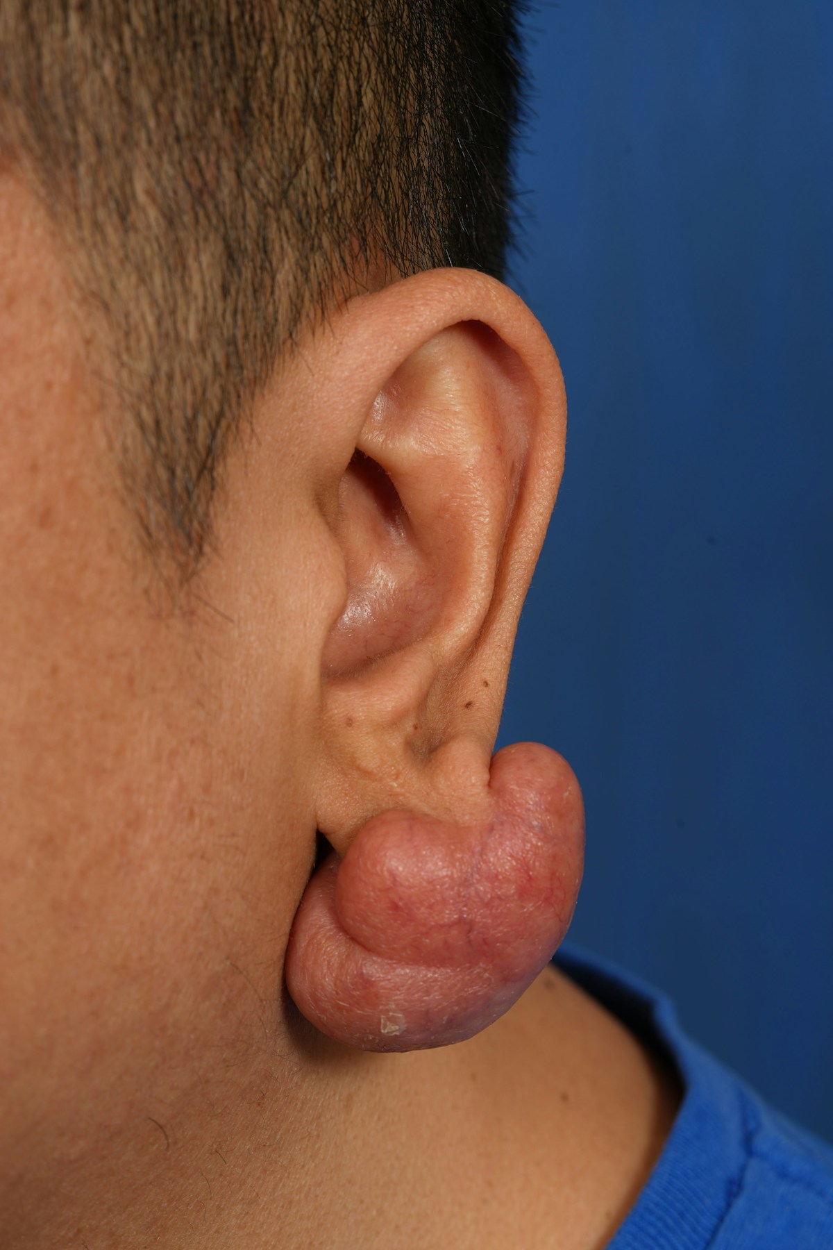 Keloid Removal Before & After Gallery - Patient 172564 - Image 1