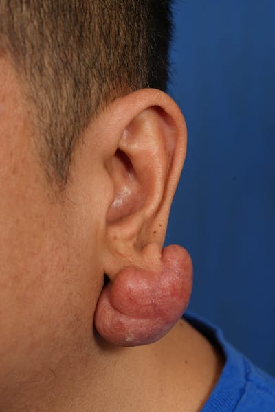 Keloid Removal Before & After Gallery - Patient 172564 - Image 1