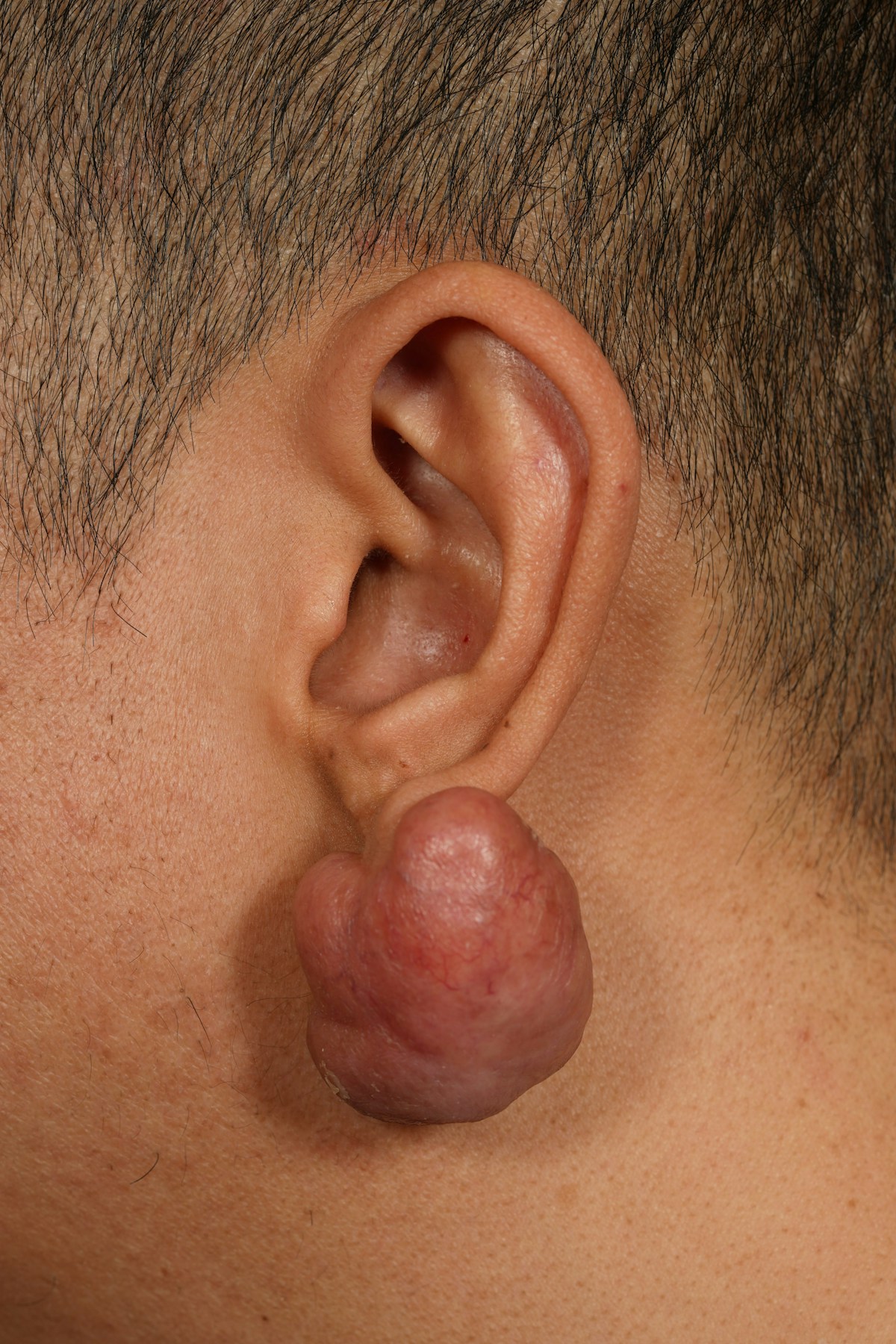 Keloid Removal Before & After Gallery - Patient 172564 - Image 3