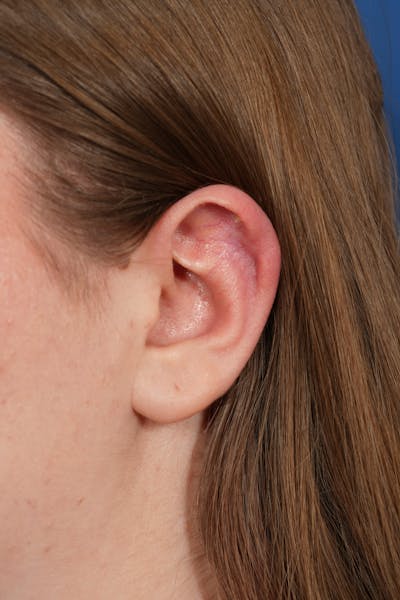 Keloid Removal Before & After Gallery - Patient 834007 - Image 2