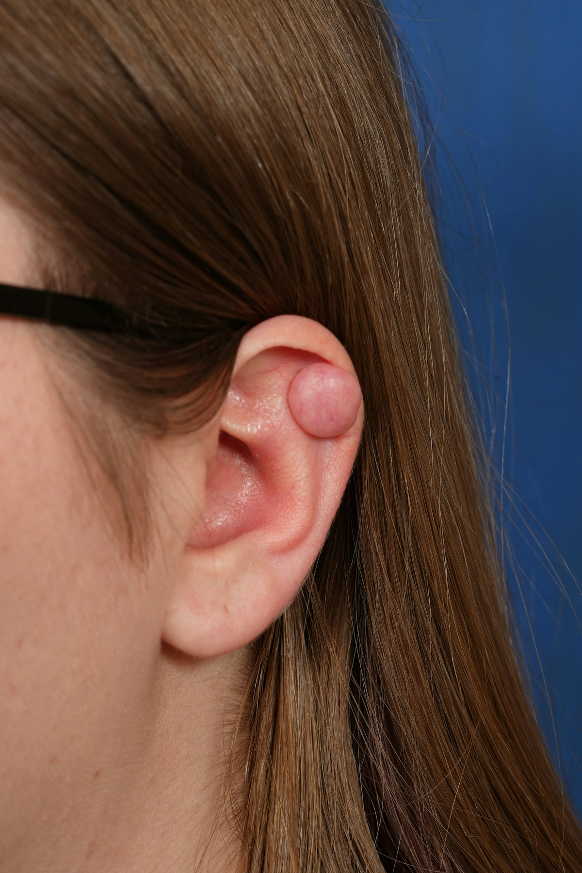 Keloid Removal Before & After Gallery - Patient 834007 - Image 1