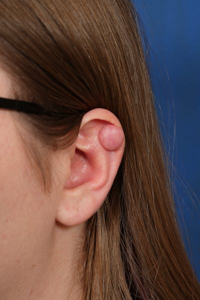 Keloid Removal Before & After Gallery - Patient 834007 - Image 1