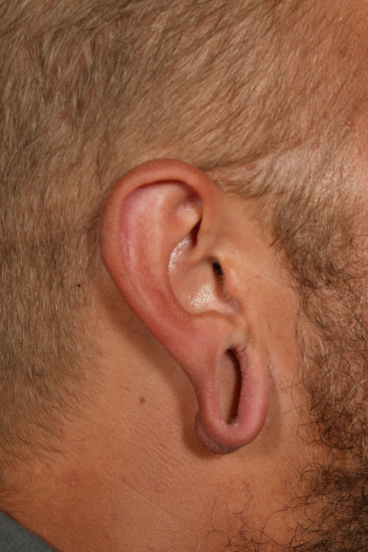 Ear Lobe Repair Before & After Gallery - Patient 279176 - Image 5