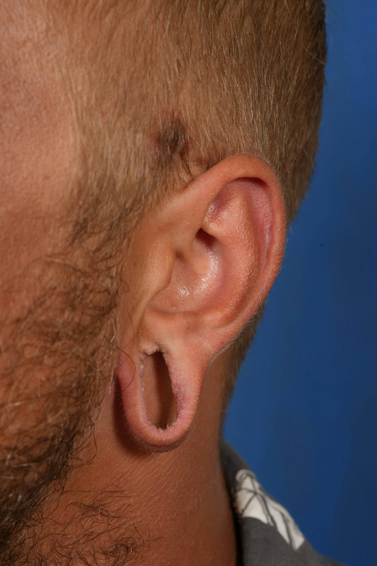 Ear Lobe Repair Before & After Gallery - Patient 279176 - Image 1