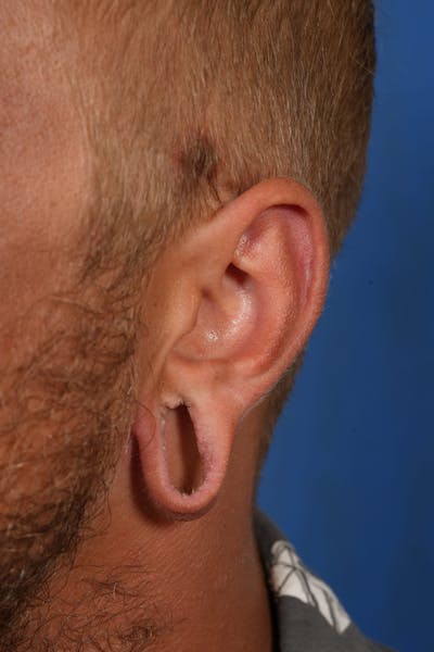 Ear Lobe Repair Before & After Gallery - Patient 279176 - Image 1