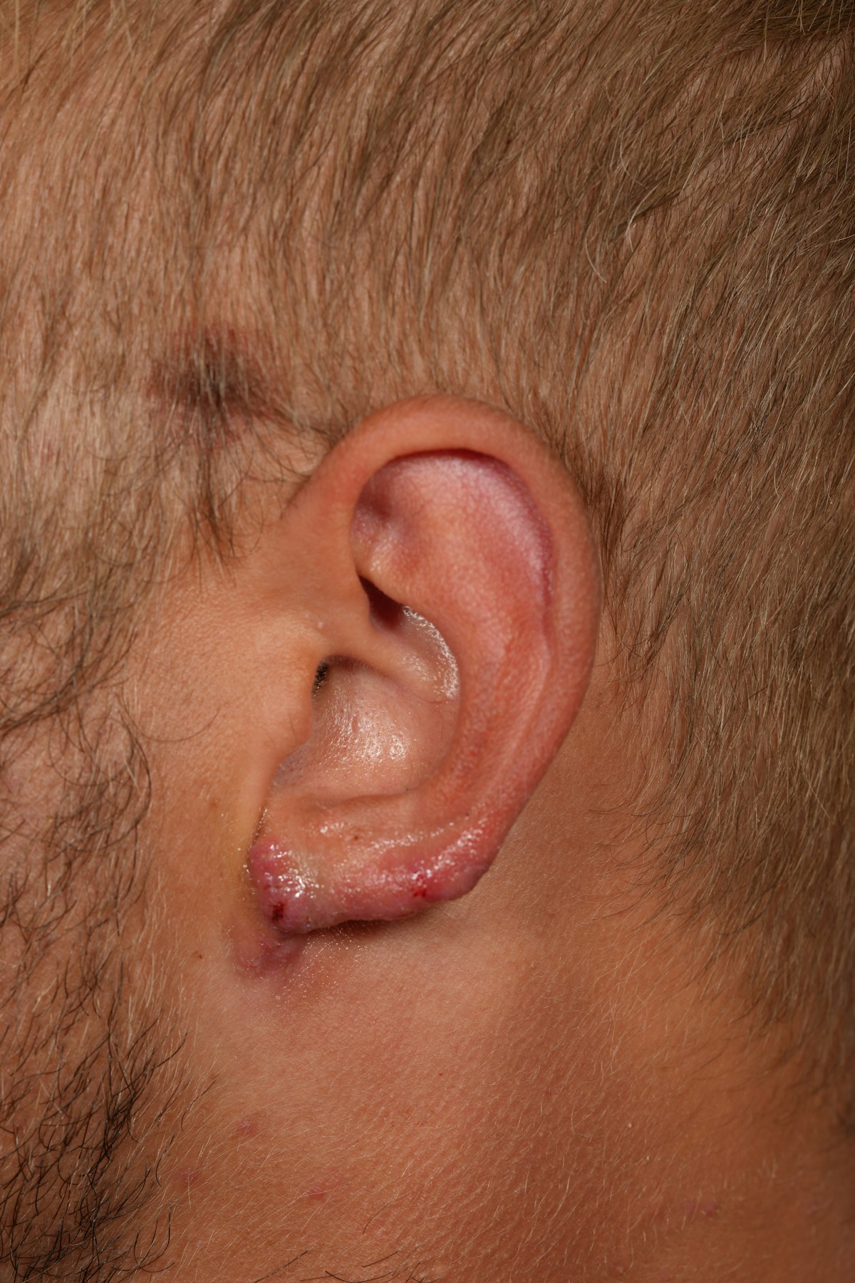 Ear Lobe Repair Before & After Gallery - Patient 279176 - Image 8