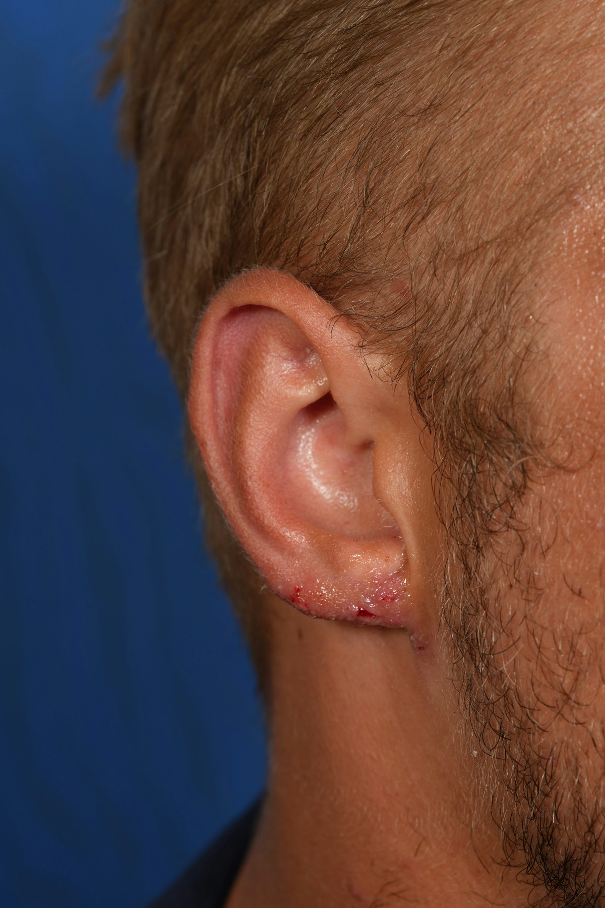 Ear Lobe Repair Before & After Gallery - Patient 279176 - Image 4