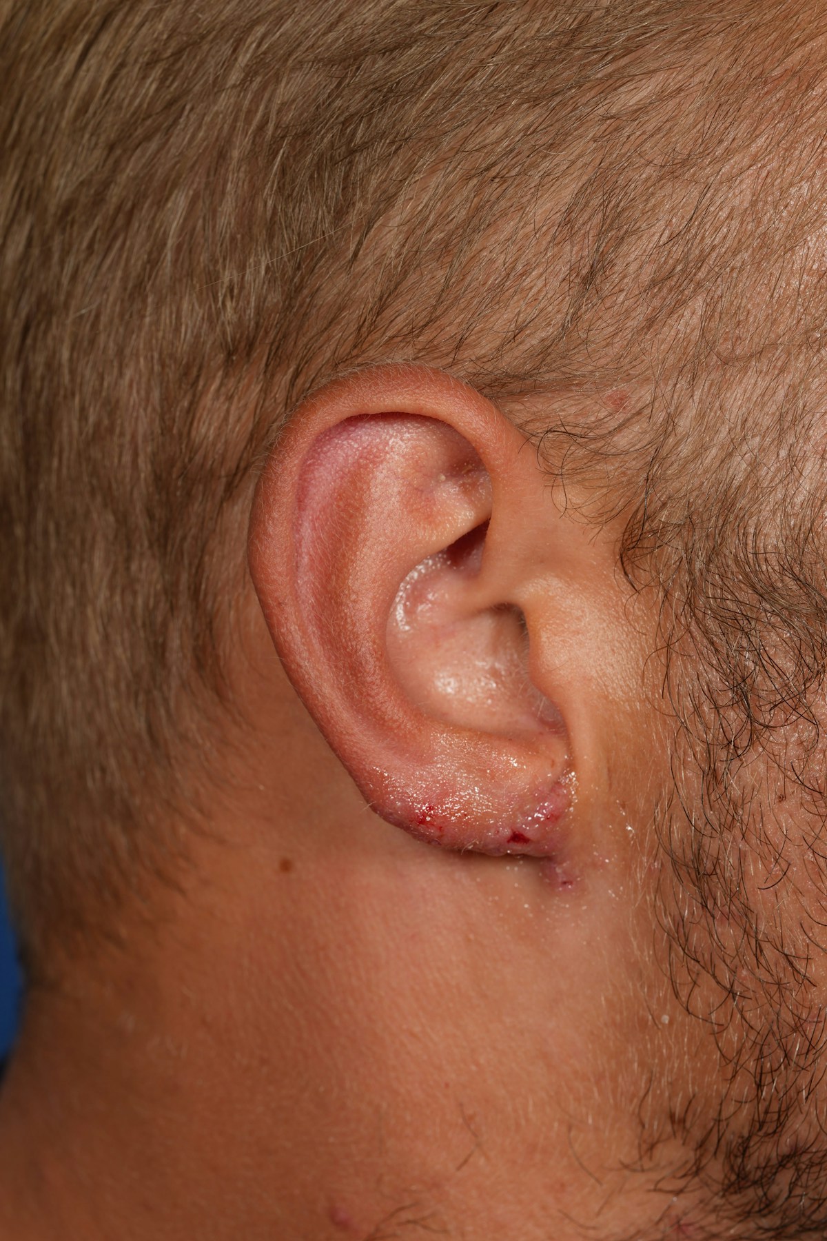 Ear Lobe Repair Before & After Gallery - Patient 279176 - Image 6